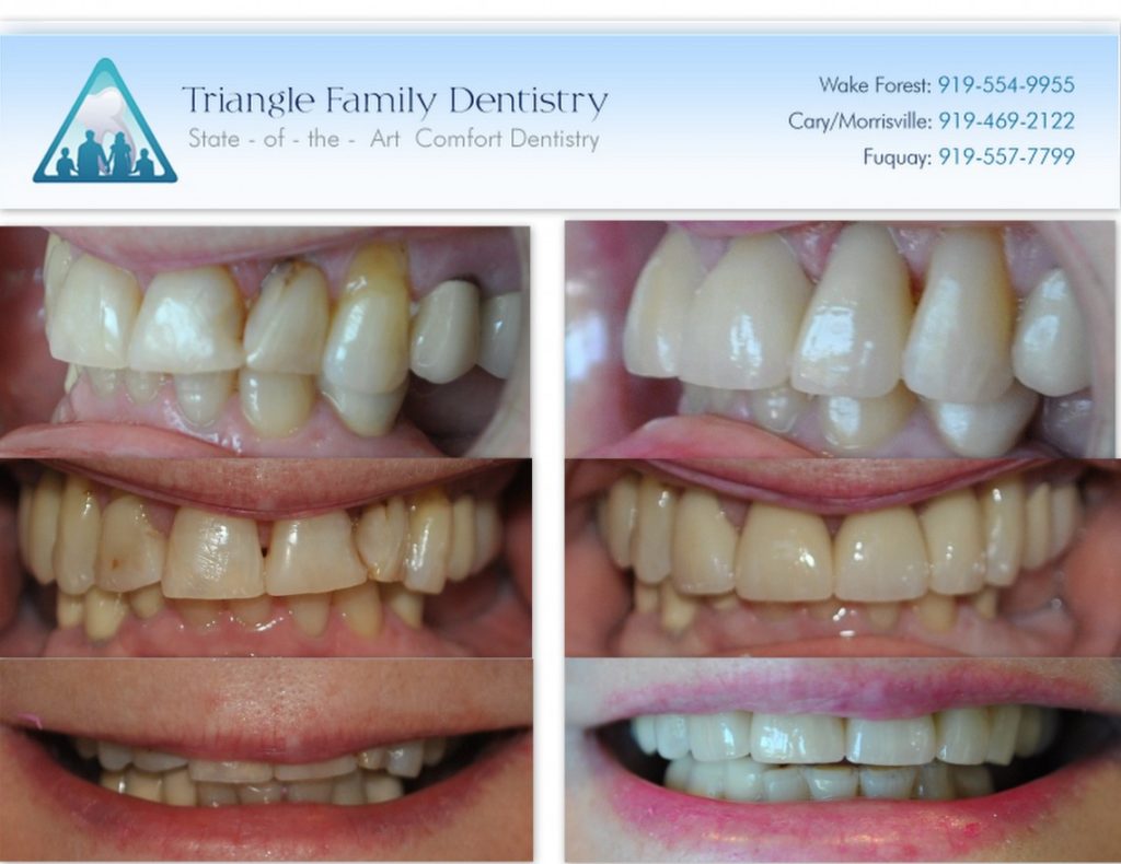 anteriorcrowns1140x880 Triangle Family Dentistry