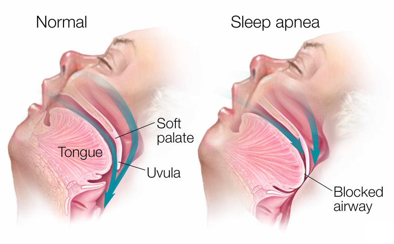 sleep-apnea-solutions-triangle-family-dentistry